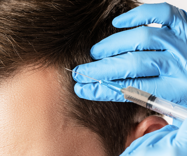 Hair restoration with PRP
