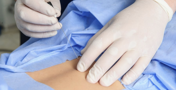 Spinal injection for pain management