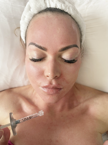 VAMP™ treatment at CIRC Aesthetics